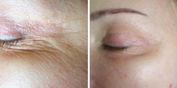 Tempsure Envi Before and After Skin Tightening Skin Tightening Before and After - Crows Feet