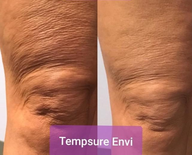 Tempsure Envi Before and After Skin Tightening1 Skin Tightening Before and After - Knees