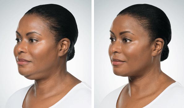 Kybella-B&A
