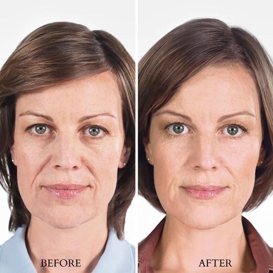 Sculptra-B&A