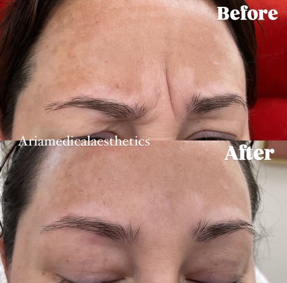 Aria Dysport results