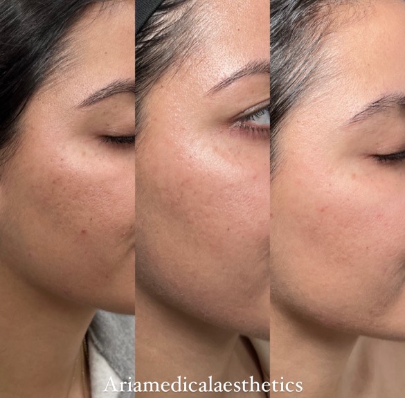 Aria Fraxel results image