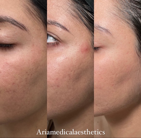 Aria Fraxel Results images