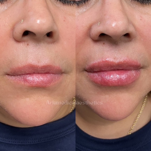 Aria Lip filler results