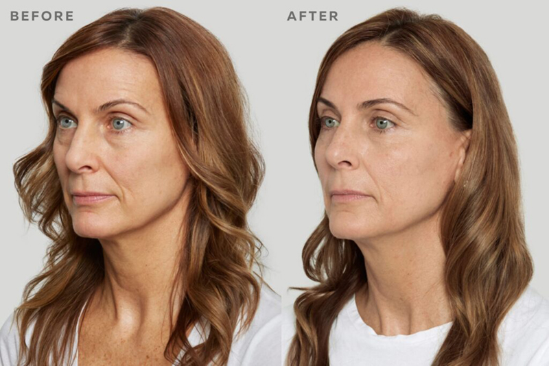 before and after sculptra Aria Sculptra before and after treatment image